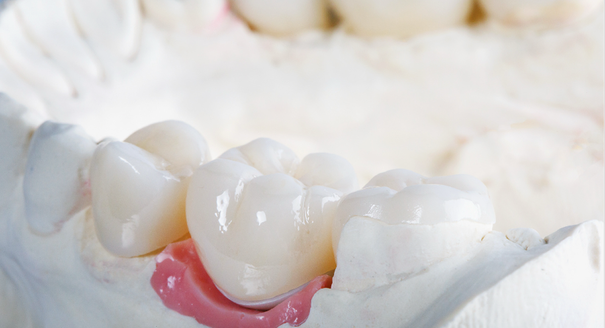 セラミック治療の相場説明