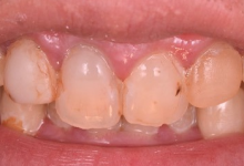 セラミック治療症例02前