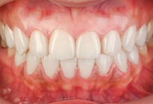 貼るホワイトニング症例01後