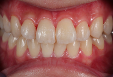 貼るホワイトニング症例01後