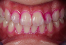 貼るホワイトニング症例01前
