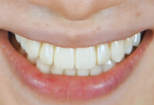 ガミースマイル症例01後