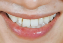 ガミースマイル症例01前