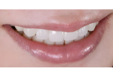 ガミースマイル症例02後