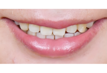 ガミースマイル症例02前