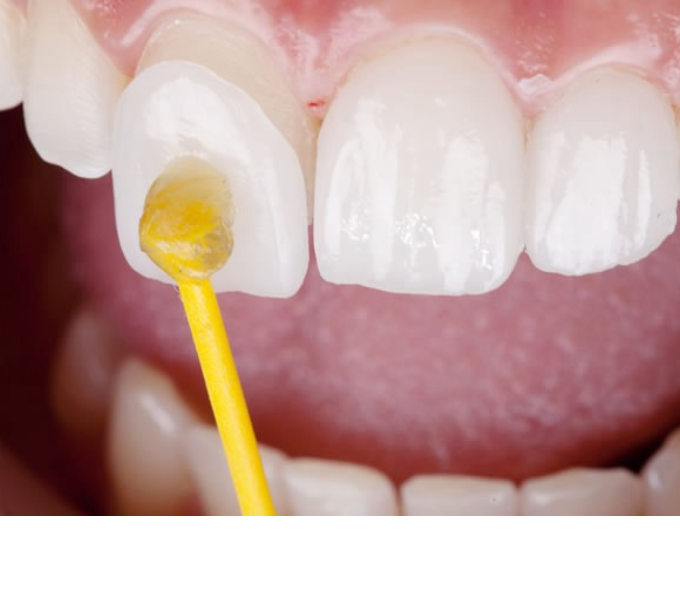 歯表面の審美歯科