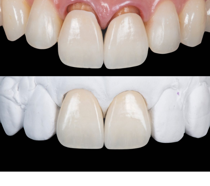 前歯の審美歯科セラミック