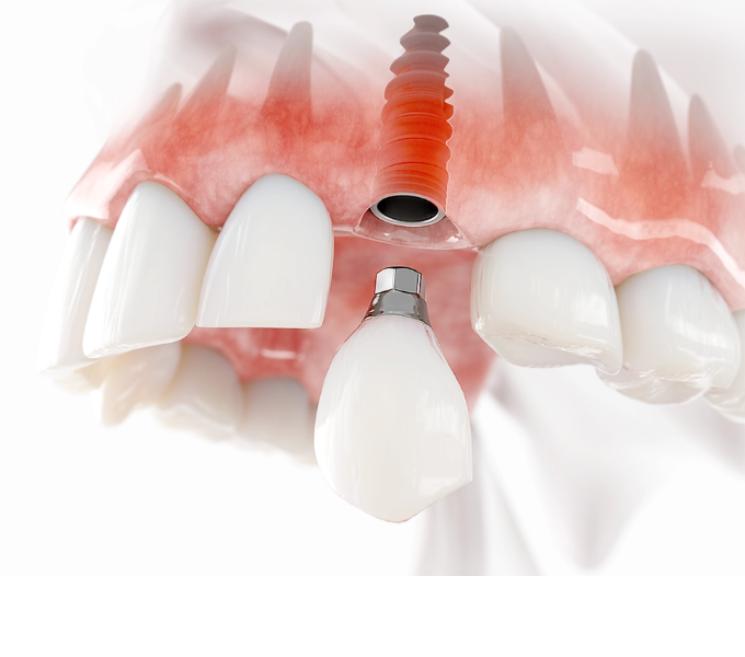 抜けた歯の審美歯科
