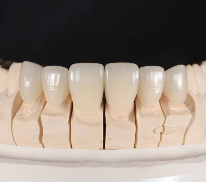 前歯の審美歯科セラミック