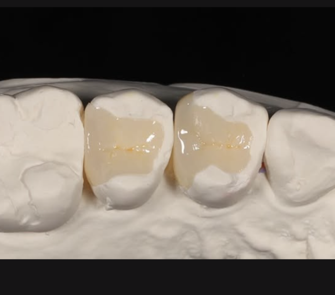 奥歯の審美歯科セラミック